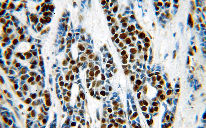 Immunohistochemical of paraffin-embedded human cervical cancer using Catalog No:114589(RBBP4 antibody) at dilution of 1:100 (under 40x lens)