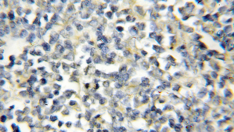 Immunohistochemical of paraffin-embedded human lymphoma using Catalog No:114525(RAG2 antibody) at dilution of 1:50 (under 10x lens)