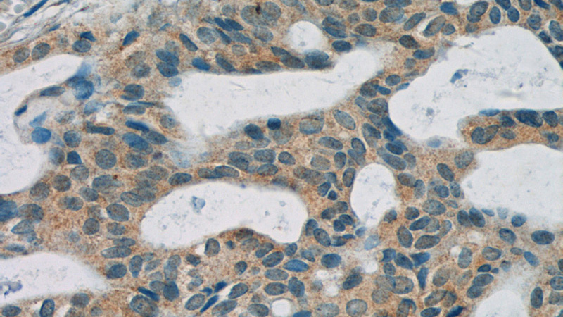 Immunohistochemistry of paraffin-embedded human breast cancer tissue slide using Catalog No:108646(C11orf83 Antibody) at dilution of 1:50 (under 40x lens)