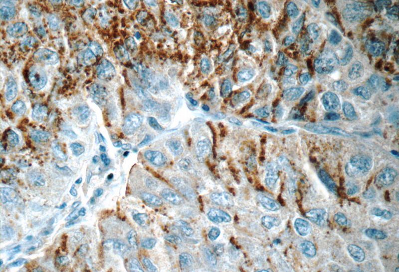 Immunohistochemistry of paraffin-embedded human lung cancer tissue slide using Catalog No:109605(CSPG4,NG2 Antibody) at dilution of 1:50 (under 40x lens)