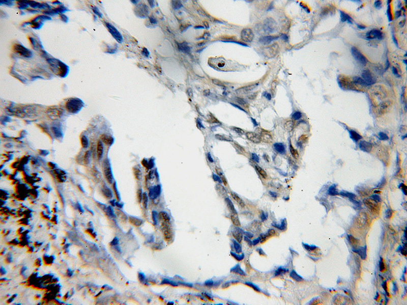 Immunohistochemical of paraffin-embedded human lung cancer using Catalog No:110458(FAM107A antibody) at dilution of 1:50 (under 10x lens)