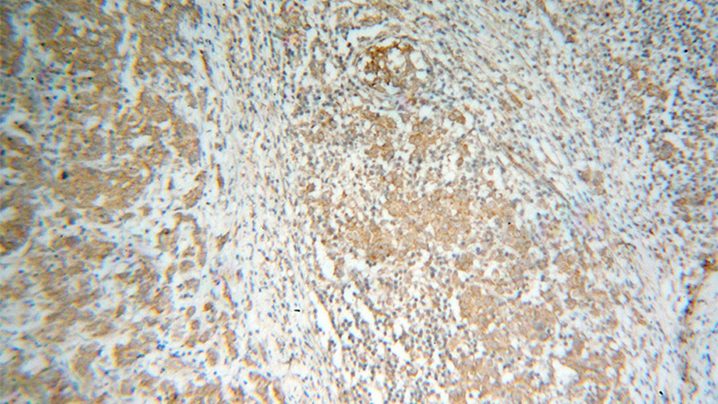 Immunohistochemical of paraffin-embedded human breast cancer using Catalog No:116850(WBSCR16 antibody) at dilution of 1:50 (under 10x lens)