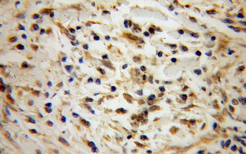 Immunohistochemical of paraffin-embedded human cervical cancer using Catalog No:114040(POLR2C antibody) at dilution of 1:100 (under 40x lens)