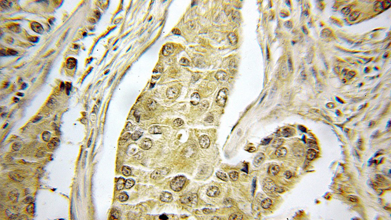 Immunohistochemical of paraffin-embedded human breast cancer using Catalog No:107715(ACTR1B antibody) at dilution of 1:50 (under 40x lens)