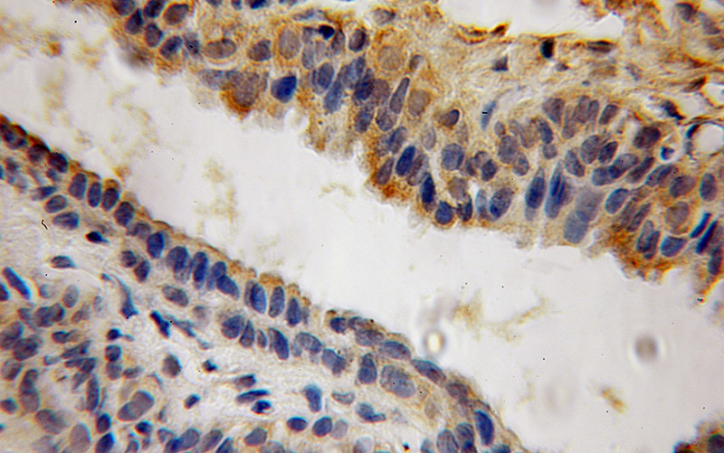 Immunohistochemical of paraffin-embedded human prostate cancer using Catalog No:107691(ACP6 antibody) at dilution of 1:100 (under 10x lens)