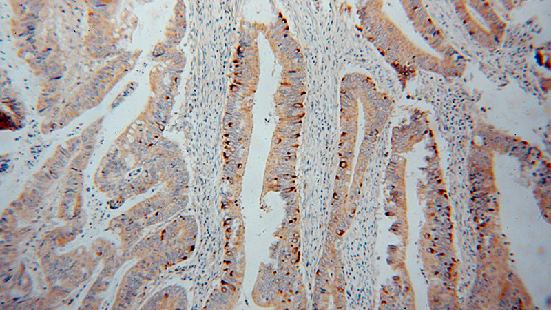 Immunohistochemical of paraffin-embedded human colon cancer using Catalog No:108940(CBR3 antibody) at dilution of 1:50 (under 10x lens)