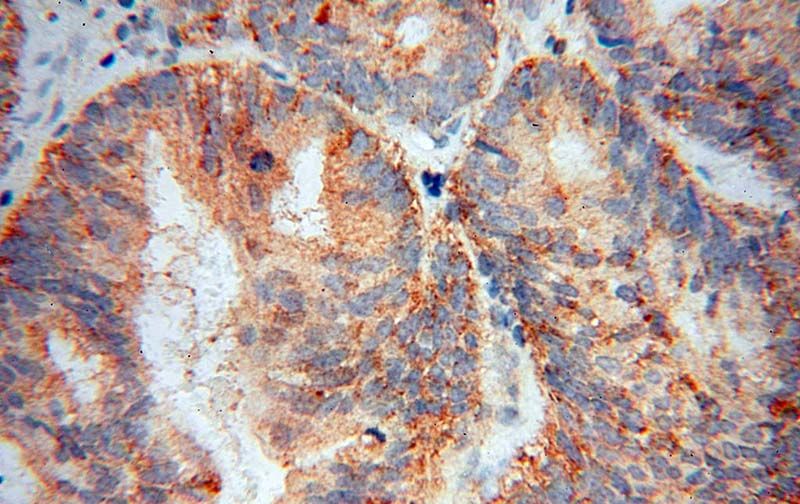Immunohistochemical of paraffin-embedded human ovary tumor using Catalog No:112021(KCTD5 antibody) at dilution of 1:50 (under 40x lens)