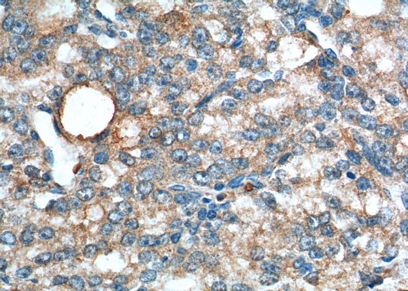 Immunohistochemistry of paraffin-embedded human prostate cancer tissue slide using Catalog No:116738(VEGFC Antibody) at dilution of 1:200 (under 40x lens).