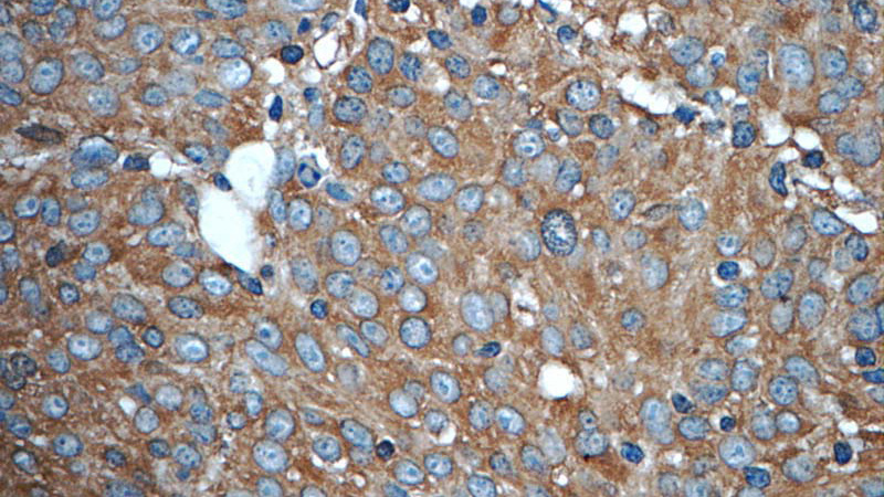 Immunohistochemistry of paraffin-embedded human lung cancer tissue slide using Catalog No:113856(PKLR Antibody) at dilution of 1:50 (under 40x lens)