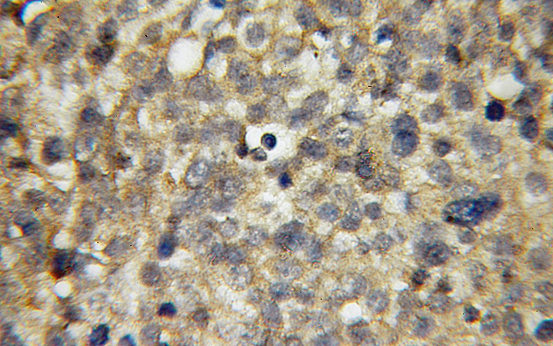 Immunohistochemical of paraffin-embedded human ovary tumor using Catalog No:108042(APPL1 antibody) at dilution of 1:50 (under 10x lens)