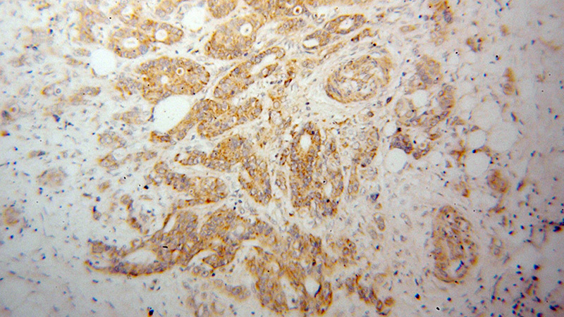 Immunohistochemical of paraffin-embedded human colon cancer using Catalog No:110041(DTYMK antibody) at dilution of 1:100 (under 10x lens)