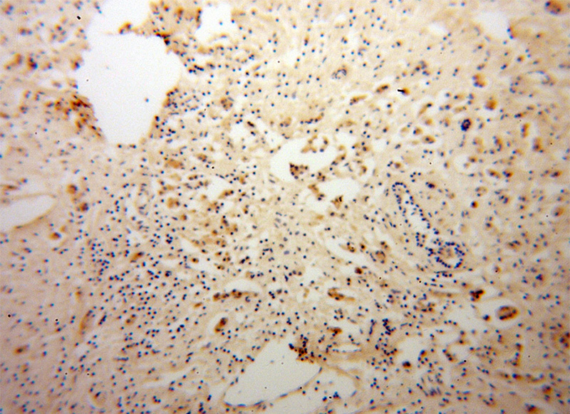 Immunohistochemical of paraffin-embedded human breast cancer using Catalog No:109949(DNAJC4 antibody) at dilution of 1:100 (under 10x lens)