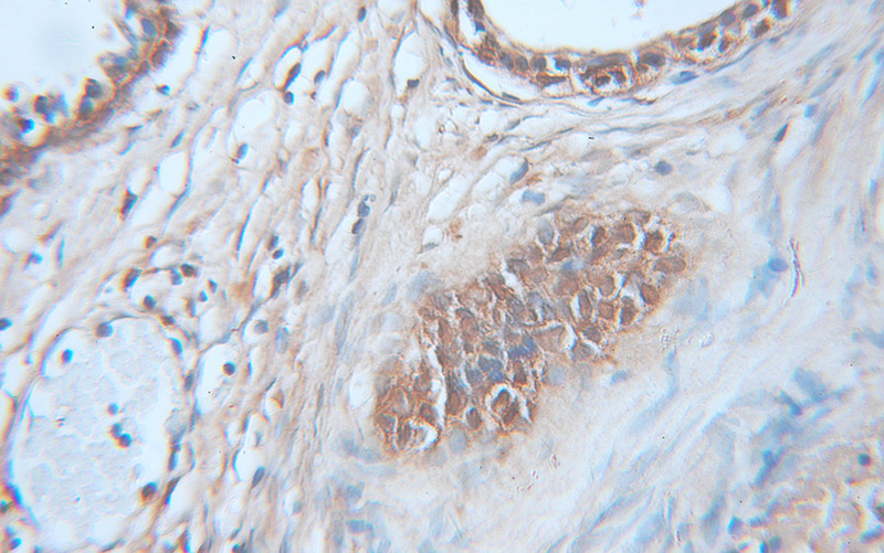 Immunohistochemical of paraffin-embedded human prostate cancer using Catalog No:108934(CAPG antibody) at dilution of 1:100 (under 10x lens)