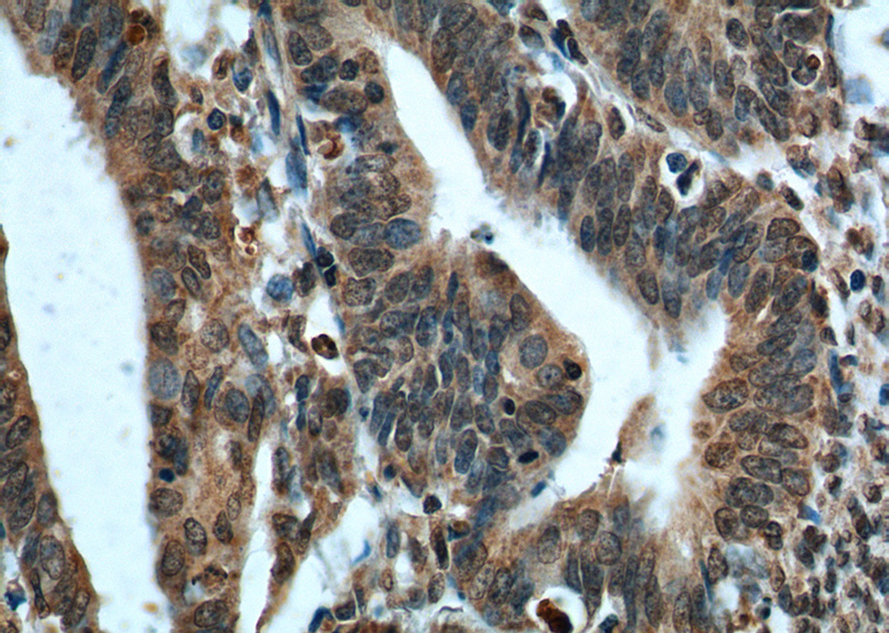 Immunohistochemistry of paraffin-embedded human endometrial cancer tissue slide using Catalog No:107490(PTEN Antibody) at dilution of 1:200 (under 40x lens). heat mediated antigen retrieved with Tris-EDTA buffer(pH9).