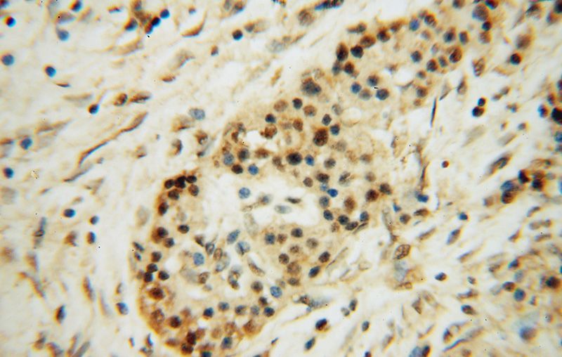 Immunohistochemical of paraffin-embedded human pancreas cancer using Catalog No:113437(OSGEP antibody) at dilution of 1:50 (under 40x lens)