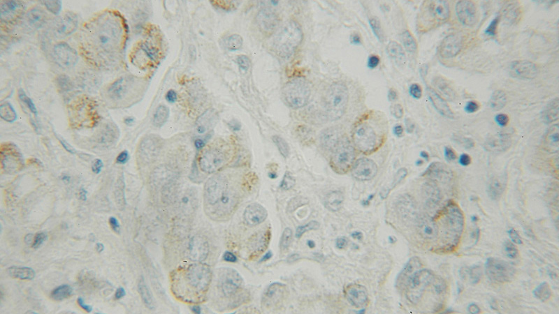 Immunohistochemical of paraffin-embedded human prostate cancer using Catalog No:110071(DPP8 antibody) at dilution of 1:100 (under 10x lens)