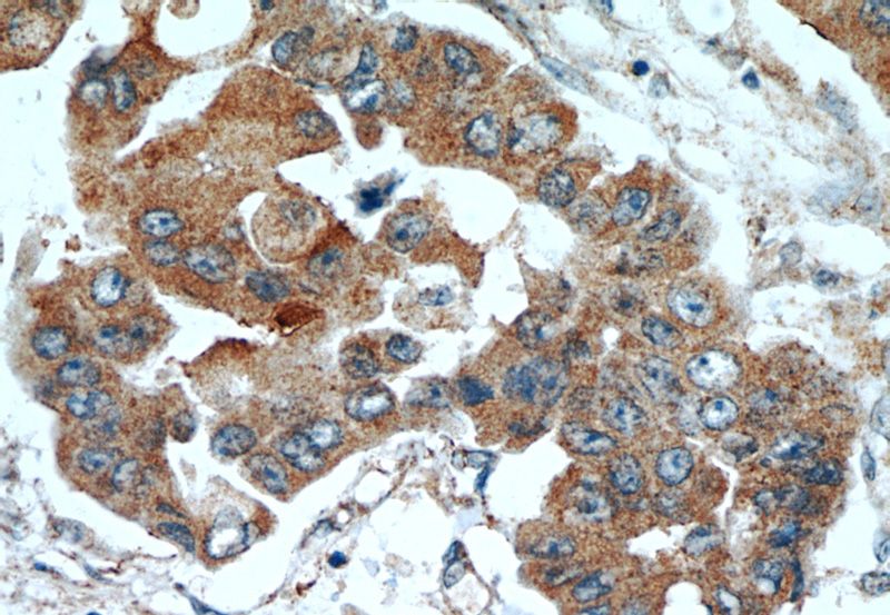 Immunohistochemical of paraffin-embedded human breast cancer using Catalog No:116267(TPM2 antibody) at dilution of 1:50 (under 40x lens)