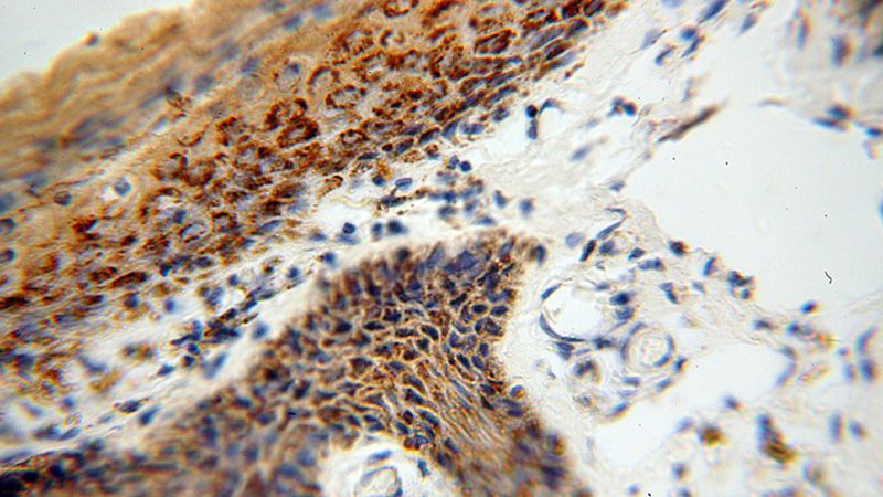 Immunohistochemical of paraffin-embedded human skin cancer using Catalog No:112132(KRT36 antibody) at dilution of 1:100 (under 40x lens)