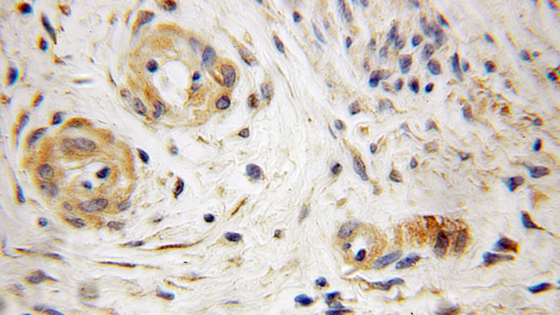Immunohistochemical of paraffin-embedded human endometrial cancer using Catalog No:114991(SCFD1 antibody) at dilution of 1:50 (under 10x lens)