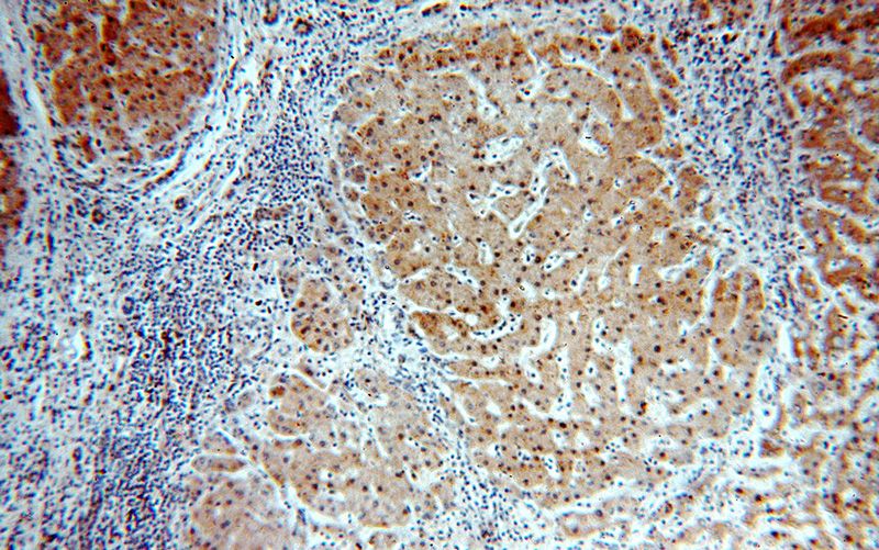 Immunohistochemical of paraffin-embedded human hepatocirrhosis using Catalog No:114497(RABGAP1L antibody) at dilution of 1:100 (under 10x lens)