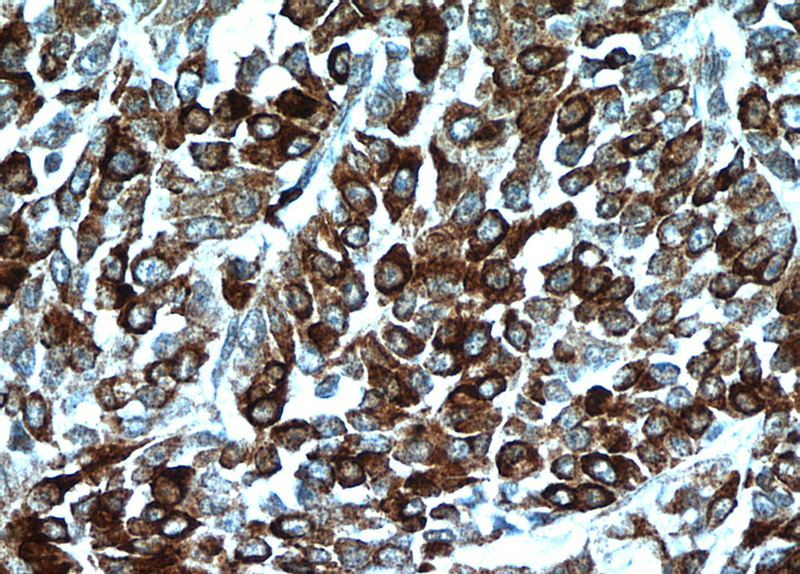Immunohistochemical of paraffin-embedded human colon cancer using Catalog No:111698(HSPA4 antibody) at dilution of 1:100 (under 40x lens)