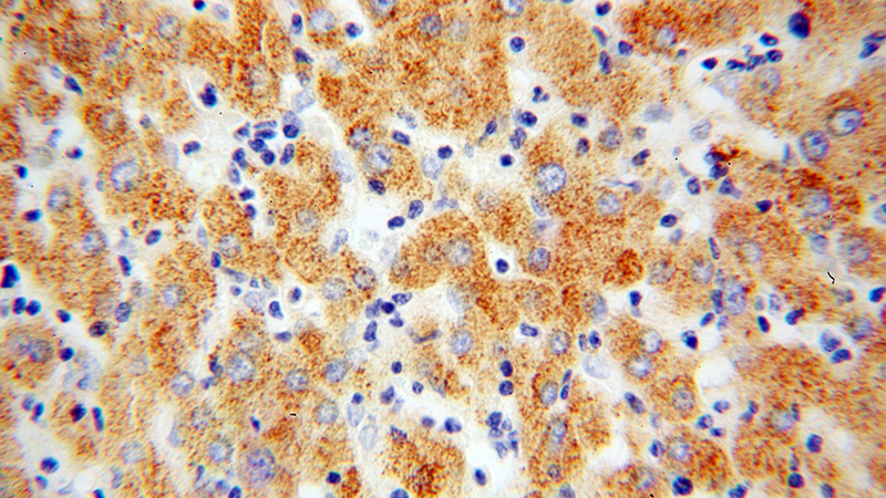 Immunohistochemical of paraffin-embedded human liver cancer using Catalog No:108690(C1S antibody) at dilution of 1:50 (under 40x lens)