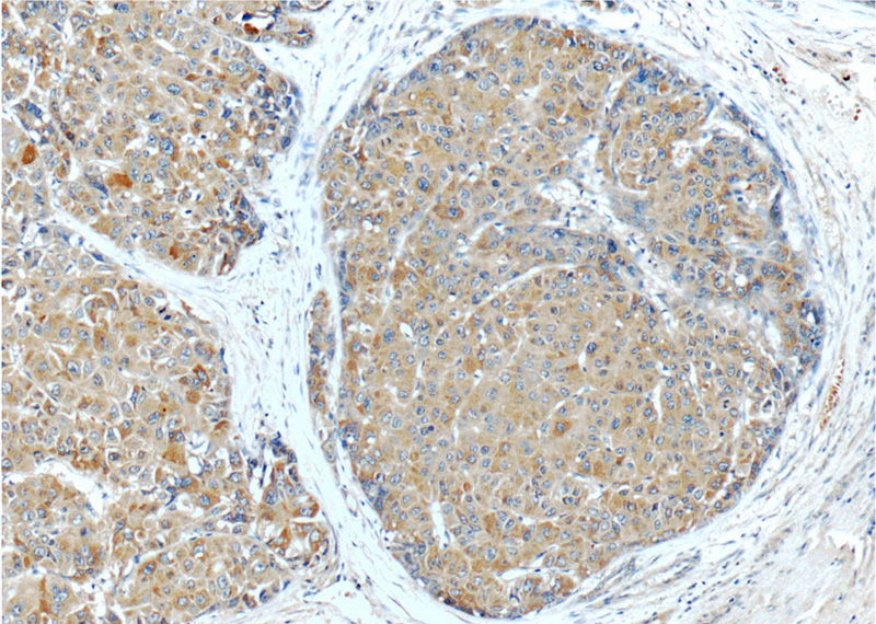 Immunohistochemistry of paraffin-embedded human liver cancer tissue slide using Catalog No:113786(PGLYRP2 Antibody) at dilution of 1:50 (under 10x lens)
