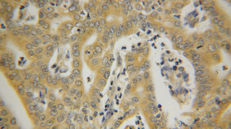 Immunohistochemical of paraffin-embedded human endometrial cancer using Catalog No:111573(HSPA1L antibody) at dilution of 1:100 (under 40x lens)