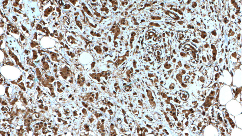 Immunohistochemistry of paraffin-embedded human breast cancer tissue slide using Catalog No:107334(NOB1 Antibody) at dilution of 1:200 (under 10x lens). heat mediated antigen retrieved with Tris-EDTA buffer(pH9).