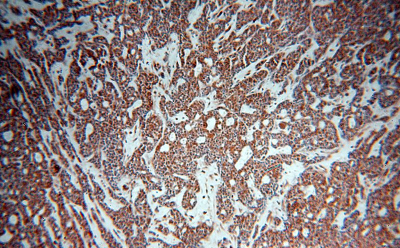 Immunohistochemical of paraffin-embedded human cervical cancer using Catalog No:116926(ZC3H4 antibody) at dilution of 1:50 (under 10x lens)
