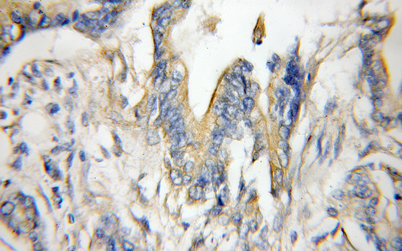 Immunohistochemical of paraffin-embedded human pancreas cancer using Catalog No:114416(RAB1A antibody) at dilution of 1:50 (under 10x lens)