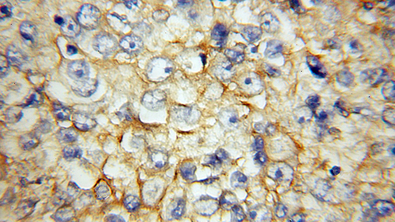Immunohistochemical of paraffin-embedded human lung cancer using Catalog No:109055(CD147 antibody) at dilution of 1:100 (under 10x lens)