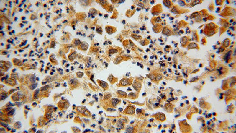 Immunohistochemical of paraffin-embedded human pancreas cancer using Catalog No:115812(STXBP4 antibody) at dilution of 1:100 (under 40x lens)