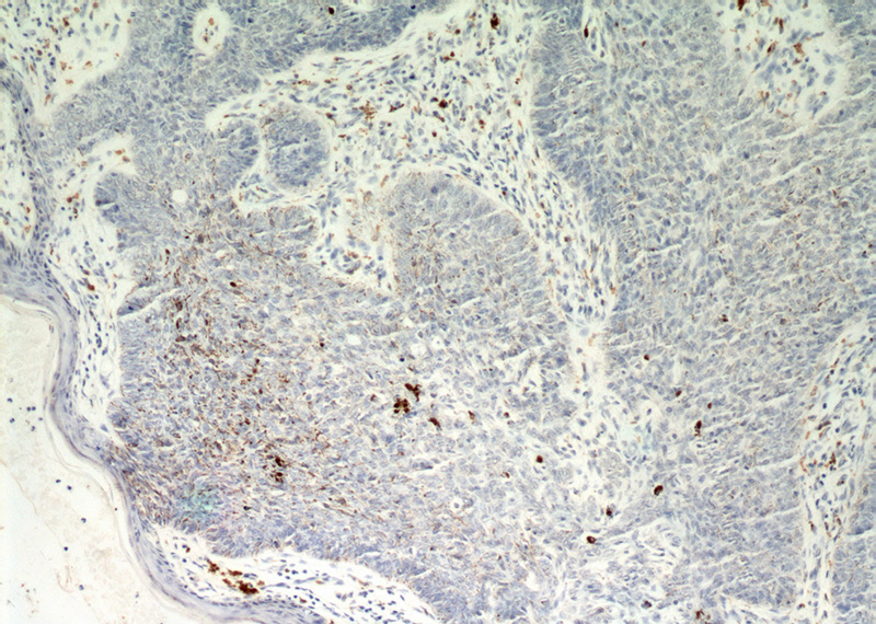 Immunohistochemical of paraffin-embedded human skin cancer using Catalog No:110216(EGFR antibody) at dilution of 1:50 (under 10x lens)