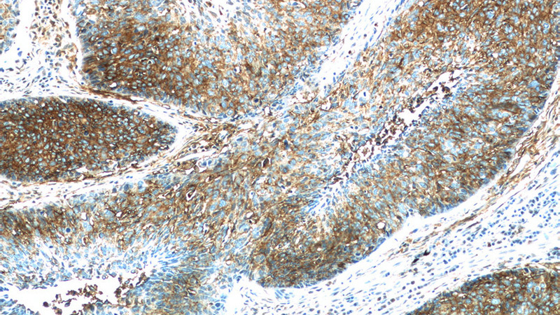 Immunohistochemistry of paraffin-embedded human lung cancer tissue slide using Catalog No:108033(APOL2 Antibody) at dilution of 1:200 (under 10x lens)