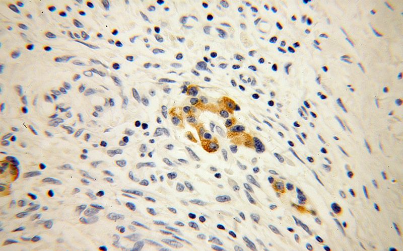Immunohistochemical of paraffin-embedded human pancreas cancer using Catalog No:112757(MPV17 antibody) at dilution of 1:50 (under 40x lens)