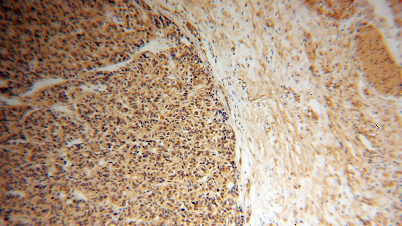 Immunohistochemical of paraffin-embedded human liver cancer using Catalog No:114468(RARB antibody) at dilution of 1:50 (under 10x lens)