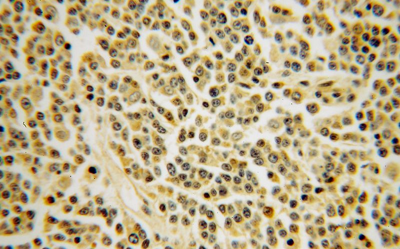 Immunohistochemical of paraffin-embedded human lymphoma using Catalog No:111808(INPP5B antibody) at dilution of 1:50 (under 40x lens)