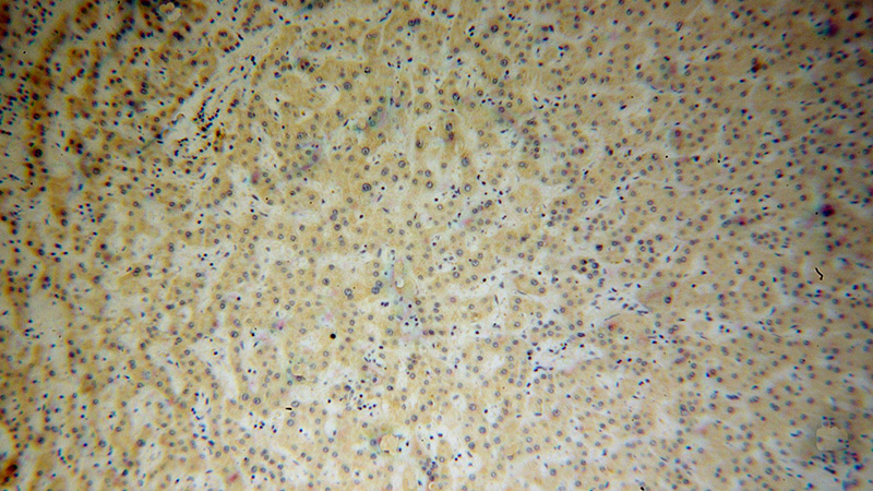 Immunohistochemical of paraffin-embedded human liver cancer using Catalog No:115771(SYT1 antibody) at dilution of 1:100 (under 10x lens)