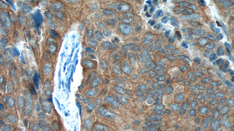 Immunohistochemistry of paraffin-embedded human colon cancer tissue slide using Catalog No:110514(FANCA Antibody) at dilution of 1:100 (under 40x lens).