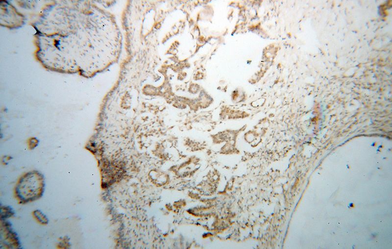 Immunohistochemical of paraffin-embedded human ovary tumor using Catalog No:117228(BRD3 antibody) at dilution of 1:50 (under 10x lens)
