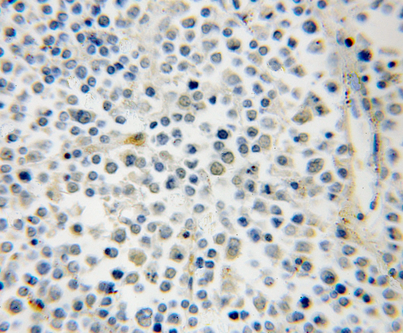 Immunohistochemical of paraffin-embedded human lymphoma using Catalog No:114438(RAB39B antibody) at dilution of 1:50 (under 10x lens)