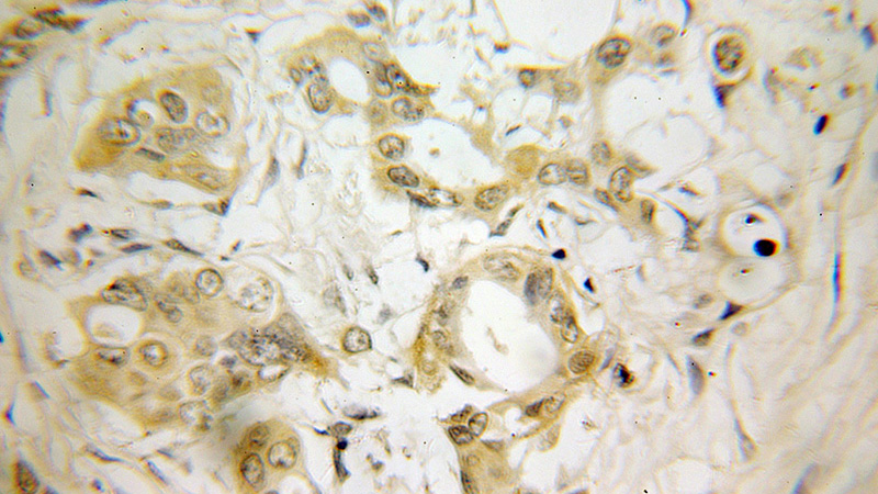 Immunohistochemical of paraffin-embedded human pancreas cancer using Catalog No:115097(SCG5 antibody) at dilution of 1:100 (under 10x lens)