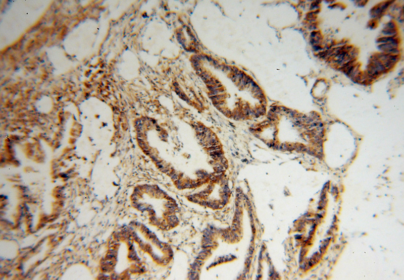 Immunohistochemical of paraffin-embedded human colon cancer using Catalog No:113642(PDXK antibody) at dilution of 1:50 (under 10x lens)