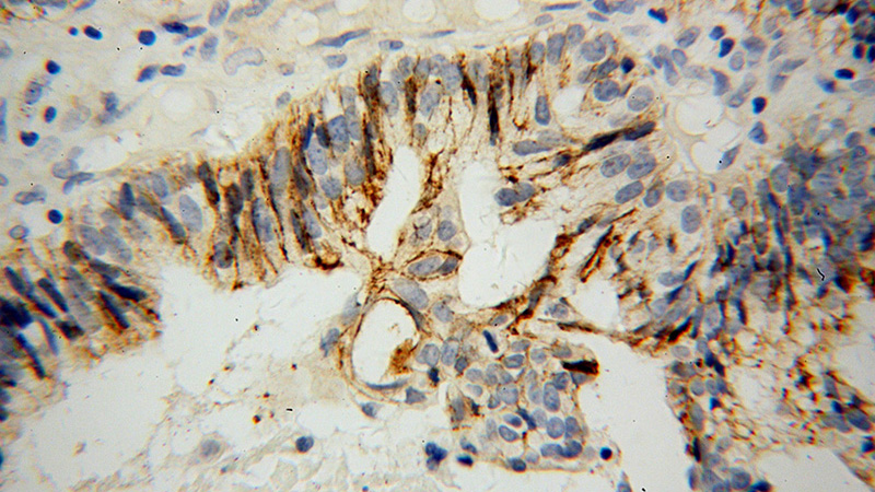 Immunohistochemical of paraffin-embedded human ovary tumor using Catalog No:109052(SDC1,CD138 antibody) at dilution of 1:100 (under 40x lens)