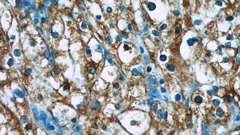Immunohistochemistry of paraffin-embedded human renal cell carcinoma tissue slide using Catalog No:117200(BMP7 Antibody) at dilution of 1:50 (under 40x lens)