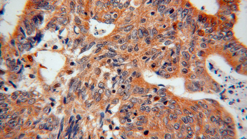 Immunohistochemical of paraffin-embedded human colon cancer using Catalog No:110268(EIF5A2 antibody) at dilution of 1:100 (under 40x lens)
