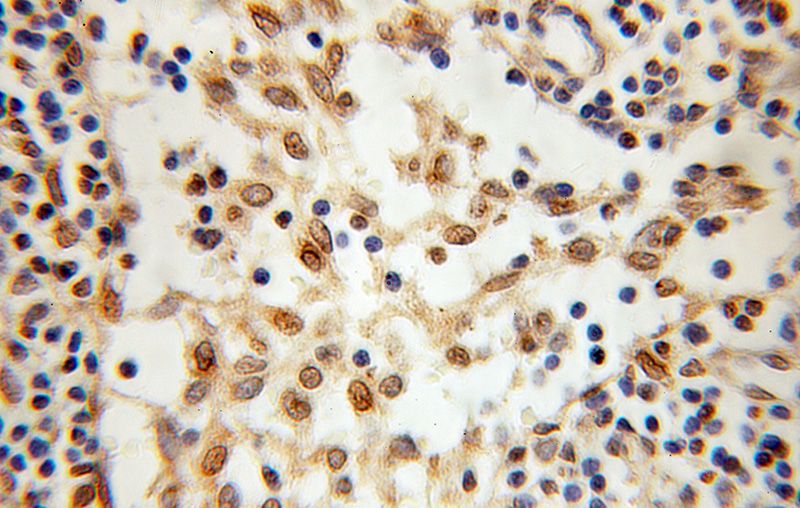 Immunohistochemical of paraffin-embedded human breast cancer using Catalog No:114599(RBM15 antibody) at dilution of 1:100 (under 10x lens)
