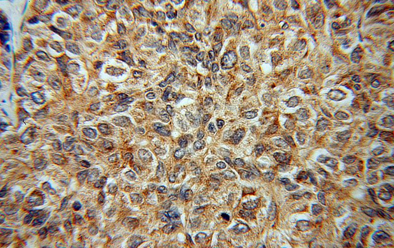 Immunohistochemical of paraffin-embedded human liver cancer using Catalog No:109725(CTNNA3 antibody) at dilution of 1:100 (under 40x lens)