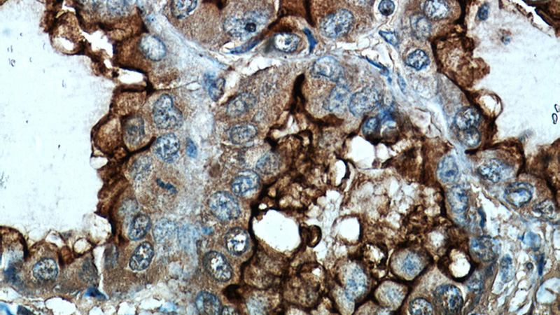 Immunohistochemical of paraffin-embedded human lung cancer using Catalog No:112888(CA15-3,MUC1 antibody) at dilution of 1:50 (under 40x lens)
